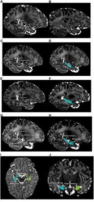 A Novel Approach for Manual Segmentation of the Amygdala and Hippocampus in Neonate MRI